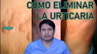 COMO ELIMINAR LA URTICARIA  RONCHAS [upl. by Eiramacissej948]