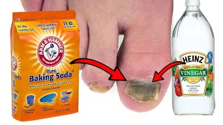 How To Get Rid of TOENAIL FUNGUS With Baking Soda amp Vinegar [upl. by Adnolohs529]