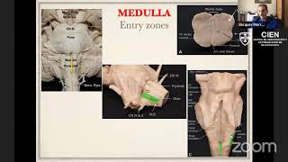 26 Brainstem Cavernomas Concepts Strategies and Technical tips by Dr Jacques Morcos [upl. by Neelhsa]