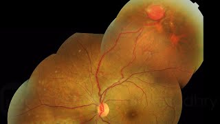 RETINAL CAPILLARY HAEMANGIOMA IN VON HIPPELLINDAU SYNDROME [upl. by Spoor]