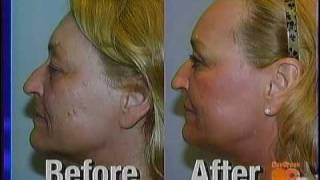 FRAXEL REPAIR  Dr Persky Facial Plastic Surgeon Encino Ca [upl. by Linson]