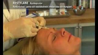 Restylane och Botox behandling [upl. by Scharff992]