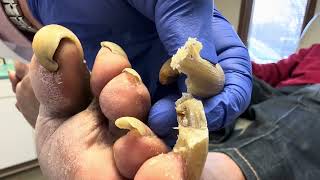 Unbelievable Toenails so long and painful that patient cannot walk [upl. by Alimak]