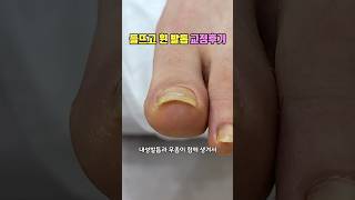 발톱이 노랗게 되거나 말린다면 미루지말고 바로 관리받으세요레푸스화정점 refusspedicarenails [upl. by Asit]