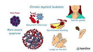 What is Chronic myeloid leukemia [upl. by Middle]