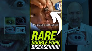 Rare Double Pupil Eye Disease Will Blow Your Mind 😱 shorts [upl. by Eam550]