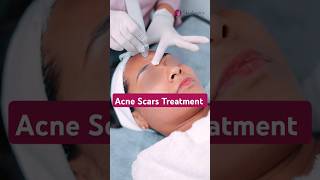 How to treat Acne Scars on face  Acne scars treatment  Acne scar treatment in noida [upl. by Enimzaj]