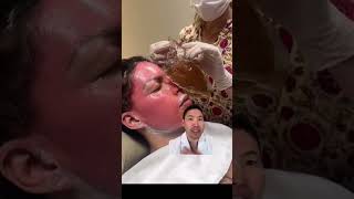 Dermatologist Explains Phenol Chemical Peels for Antiaging [upl. by Josey900]