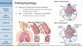 Asthma [upl. by Charity]