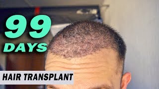 FUE Hair Transplant DAY 99 post op Istanbul Turkey GORWTH STAGE [upl. by Grigson]