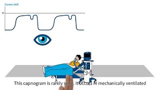 MedEd capnography byte 17 Curare cleft [upl. by Keyes]