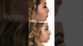 Get your nose ready nonsurgicalrhinoplasty liquidrhinoplasty nonsurgical [upl. by Sitrik941]