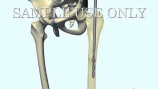 Femoral Fracture Fixation Surgery Intramedullary Nail [upl. by Htnamas]