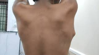 Osteochondroma Scapula  Very Interesting Case Dr Sai Chandra MBBS DNB Ortho [upl. by Yerdua]