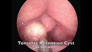 Tonsillar Retention Cyst  Incision and Drainage  Dr Sunil Kewat [upl. by Modern646]