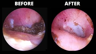 Infection and Ear Wax BEFORE AND AFTER Antibiotic Drops 928 Otomize [upl. by Esau792]