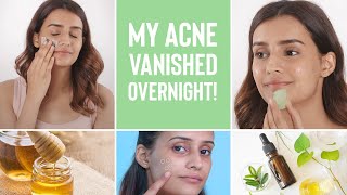 How To Make Your Acne Disappear Overnight  4 Home Remedies For Pimples [upl. by Oika864]