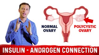 Why Does Insulin Cause PCOS Polycystic Ovary Syndrome – DrBerg [upl. by Jackelyn]