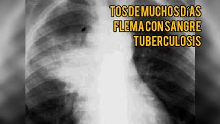 TOS DE VARIOS MESES FLEMA CON SANGRE SÍNTOMAS DE TUBERCULOSIS PULMONAR [upl. by Vinna]