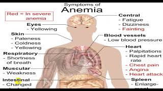 MICROCYTIC HYPOCHROMIC ANEMIA 4TH YR [upl. by Eitsud]