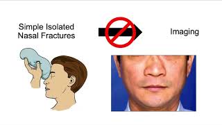 Approach to Nasal Fractures [upl. by Vorfeld]