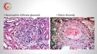 Transplantation Immunology and Pathology of Rejection [upl. by Ennairrek]