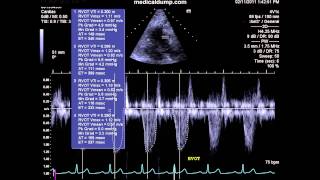 Congenital Pulmonic Valve Stenosis  Transthoracic Echocardiogram TTE [upl. by Richart433]