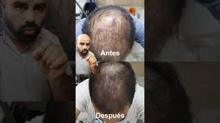 Antes y Después de un cliente que ya recuperó su cabello alopecia [upl. by Pia]