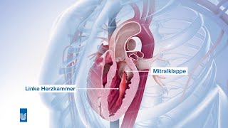 Mitralinsuffizienz OP  Medizinische Animation [upl. by Aker731]