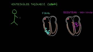 Ventriküler Taşikardi VT Fen Bilimleri Sağlık ve Tıp [upl. by Seana422]