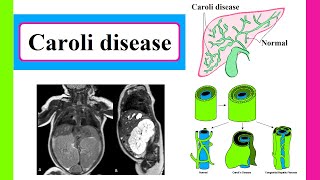 Caroli disease [upl. by Ylicis]