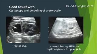 Cystoscopy amp deroofing treatment for ureterocele in a child Dr AKSingal Mumbai India [upl. by Dorkus]