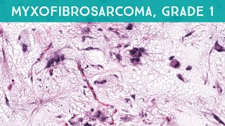 Myxofibrosarcoma grade 1low grade explained in 5 minutes dermpath dermatology sarcoma pathology [upl. by Wilkey]