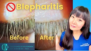 Best Blepharitis Treatments at Home  Simple amp Effective  Step by Step Guide Eye Surgeon Explains [upl. by Deeann245]