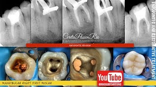 one visit endodontic retreatment mandibular molar rebilda dc spesialis konservasi gigi [upl. by Niawat]