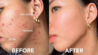 EASY WAY TO GET RID OF ACNE tiny bumps redness texture acne scars [upl. by Egreog]