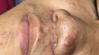 ACNE TREATMENT VU QUYNH MI  Blackheads On Boy Nose 2024FULL [upl. by Asiak597]