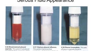 Chapter 10 Serous Fluid analysis [upl. by Godbeare]