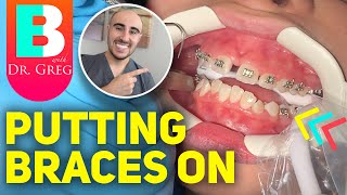 Getting Braces Put On and COLORS Vlog of Time Lapse [upl. by Akcirderf]