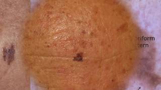 Difficult seborrheic keratoses  Dr Caterina Longo [upl. by Annah218]