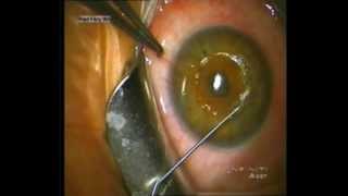 Dr Riad Fikry  Simultaneous Corneal Ring Segment Insertion and Corneal Crosslinking [upl. by Frederich]