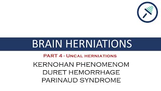 BRAIN HERNIATIONS 44 Uncal herniationDuret Hemorrhage Kernohan Phenomenom amp Parinaud Syndrome [upl. by Ayatahs]