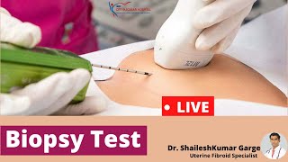 Live Biopsy Test  How Biopsy Test is Done  biopsy test kaise hota hai [upl. by Pernell793]