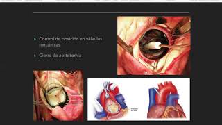 Cirugía de Valvula Aórtica  Dr Marcos Kalbermatten [upl. by Nwahsir]