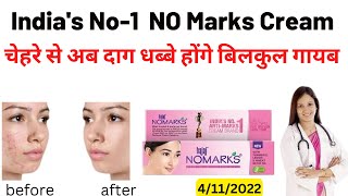 No marks Cream Review  bajaj nomarks [upl. by Assisi]