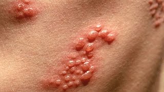 Home Remedies for shingles [upl. by Elamef395]