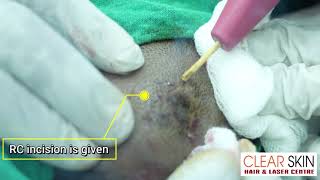 Nevus Sebaceous Of Jadasohn Removal By RC Excision Treatment  Clear Skin Hair and Laser Centre [upl. by Mchale]