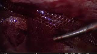 Laparoscopic Ventral Hernioplasty 24 Uzma [upl. by Kola]