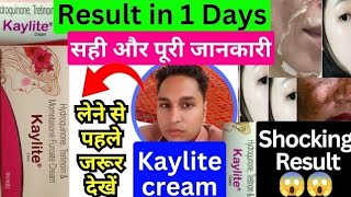 kaylite cream  kaylite cream ke fayde  kaylite cream lagane se kya hota hai  kaylite cream review [upl. by Orpah]