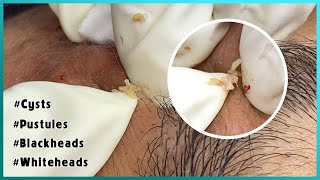 Big Cystic Acne Blackheads Extraction Blackheads amp Milia Whiteheads Removal Pimple Popping [upl. by Eniawed]